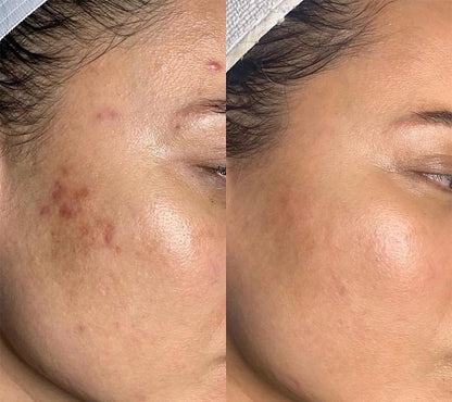 [Dr.Melaxin Official] Peel Shot Spray